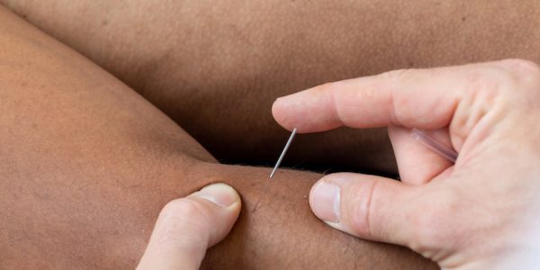 dryneedling eelboogklachten hilversum